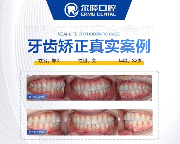 成都成人矫正牙齿咬合疼不疼？效果和费用全解析