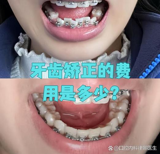 成人矫正牙齿咬合_成人牙齿咬合矫正能成功吗_成人牙齿矫正咬合多少钱