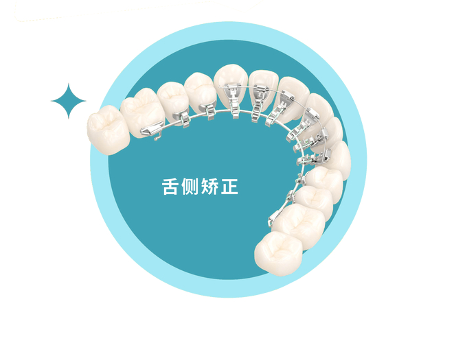 成都成年人牙齿舌侧正畸到底值不值？看完这几点就懂了