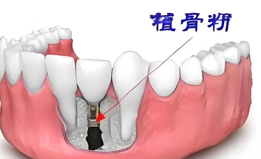 成都5000元的种植牙靠谱吗