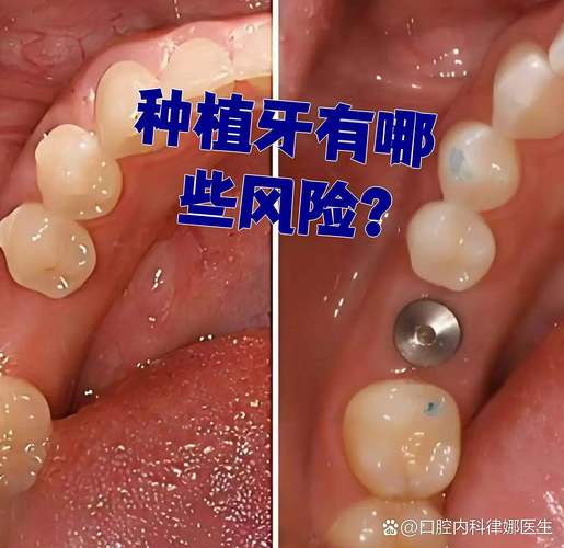 成都全口种植牙的风险和后遗症有哪些