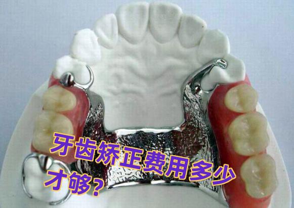 成都长沙矫正牙齿费用一览：从几千到几万差在哪