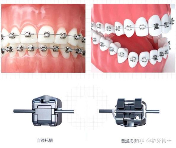 成都暴门牙矫正费用一览