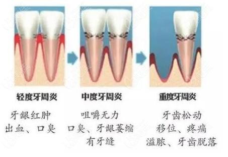 成都深圳牙周炎治疗到底要花多少钱？2026最新费用解析