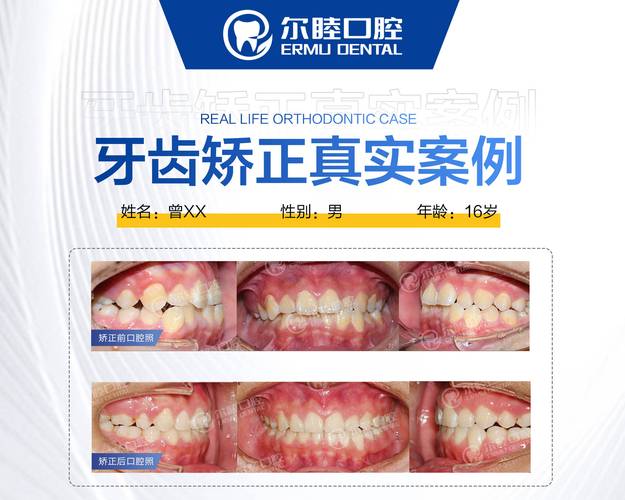 天津口腔医院牙齿矫正多少钱_天津口腔医院牙齿矫正费用_天津口腔医院矫正牙齿费用明细