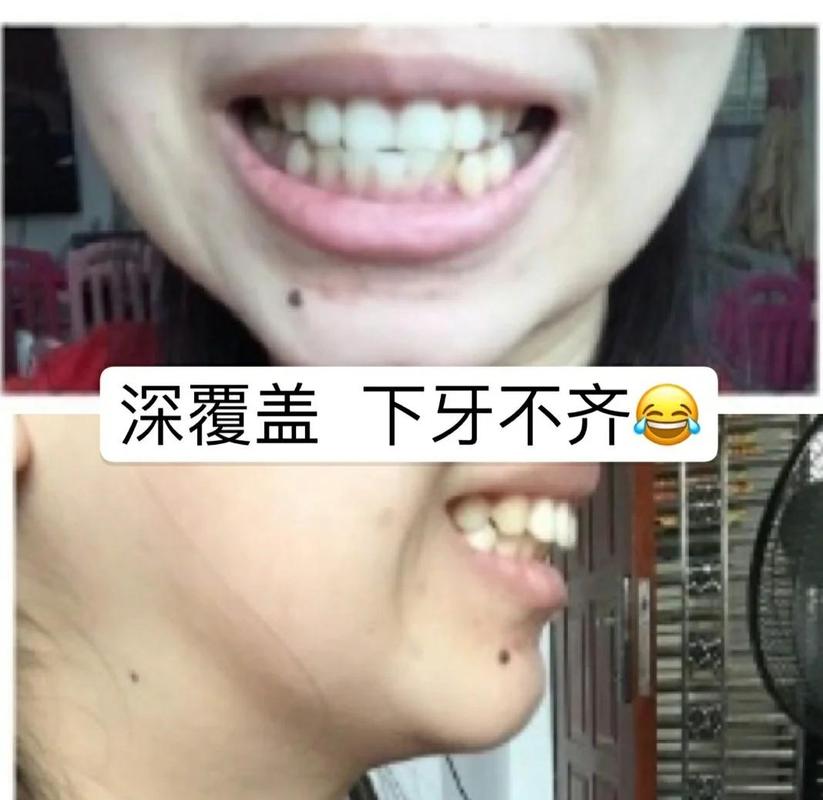 成都39岁牙齿矫正还有用吗 真实效果看这里