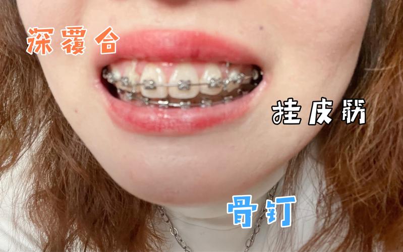 成都深圳深覆合正畸去哪家好？牙科推荐避坑指南